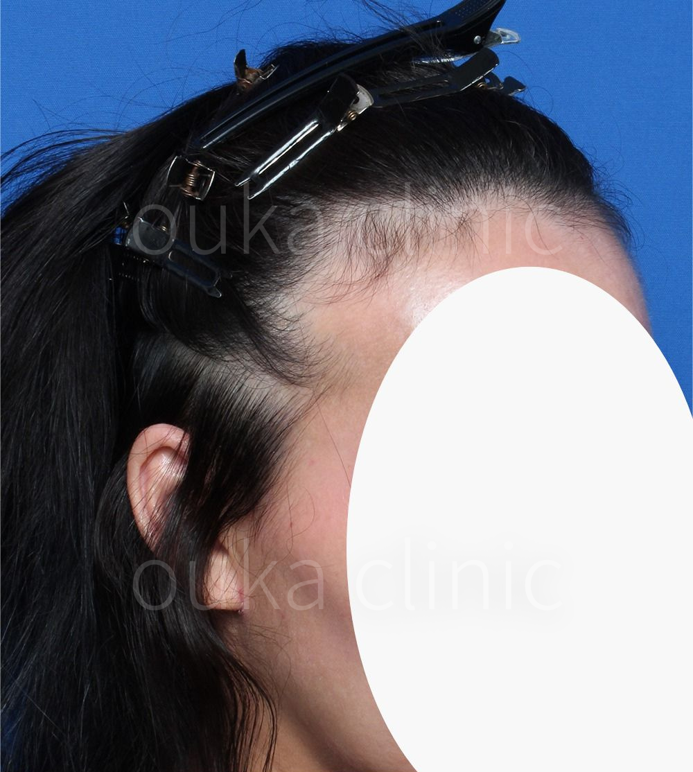 生え際、分け目の治療前の画像